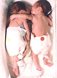保育箱里的柯瑞尔(右)用左手搂住布里埃尔，奇迹般的挽救了她的性命。