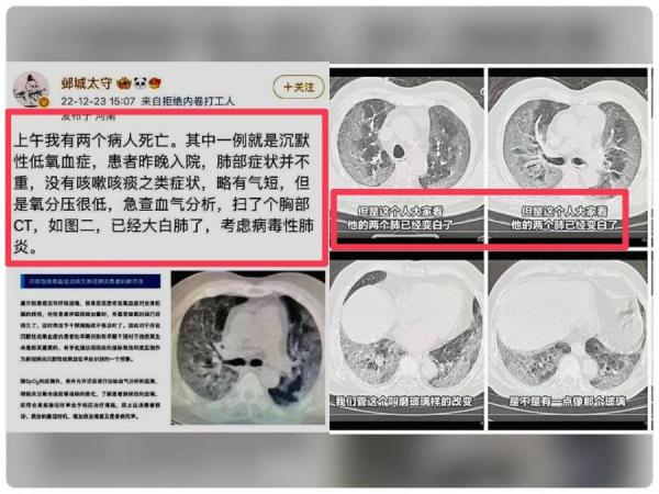 中国大陆疫情大爆发，民众纷纷亮出自己或亲人感染新冠肺炎的白肺照片。  医师 : 患者性命堪忧。（图片来源：微博）