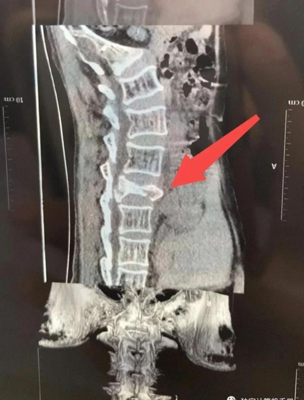 邓召美腰椎三处骨折。     （图片来源：网络截图）